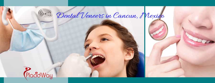 Veneers in Cancun, Mexico $2500 for Full Set of Smile Makeover